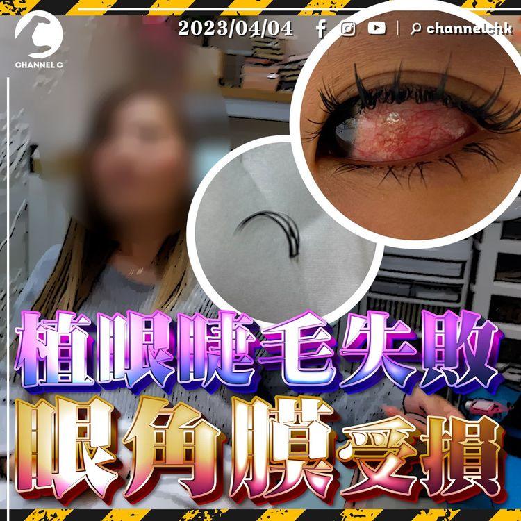 女生注意！植眼睫毛失敗 倒插眼球疑致眼角膜受損 店主：卸睫毛要敷三個鐘