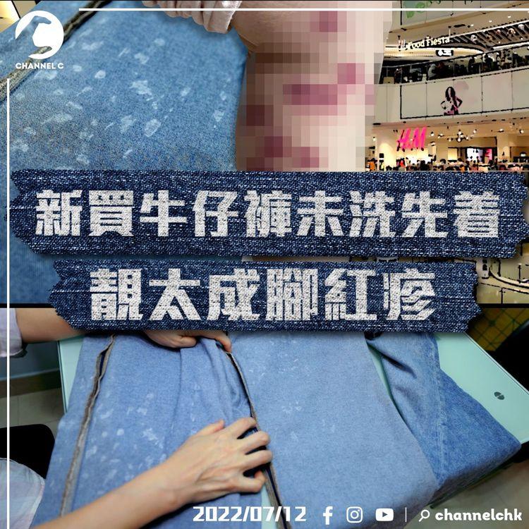恐怖！靚太買H&M牛仔褲 著完疑似出滿疹痕到癲一撻撻！H&M派人收走條褲做化驗