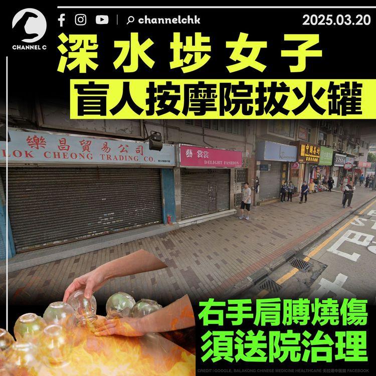 深水埗女子盲人按摩院拔火罐　右手肩膊燒傷須送院治理