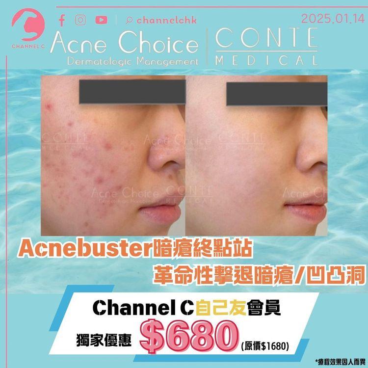 「Acnebuster 暗瘡終點站綜合治療」三合一技術
