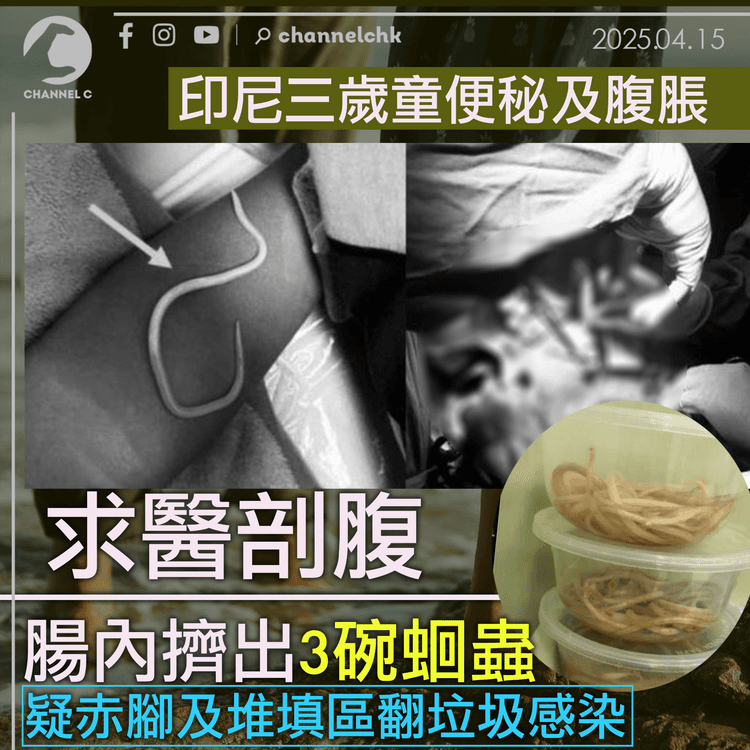 印尼三歲童便秘及腹脹　求醫剖腹腸內擠出3碗蛔蟲　疑赤腳及堆填區翻垃圾感染